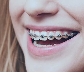 Metal Braces