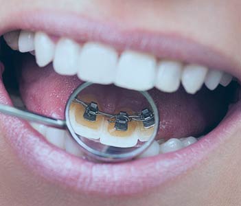Lingual braces